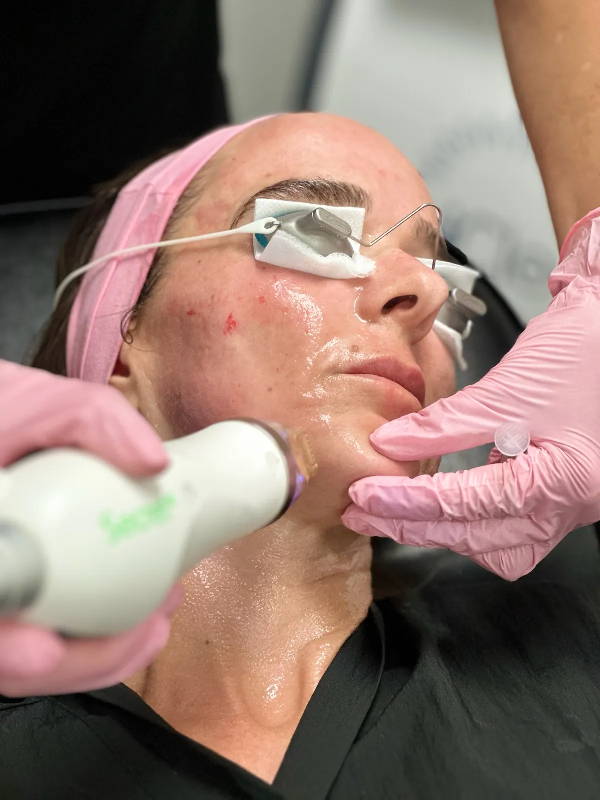 Laser facial treatment at MedGlo